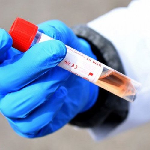 Azərbaycanda daha 136 nəfərdə koronavirus aşkarlandı - 3 nəfər vəfat etdi, 71 nəfər sağaldı